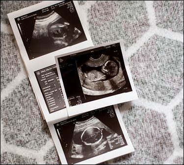 Three fetal ultrasound prints